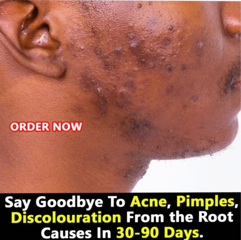 A Acne