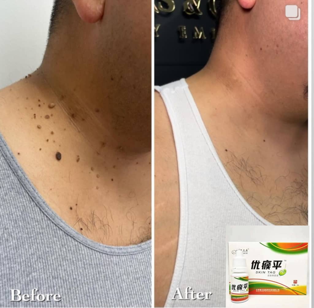 skin-tag-2