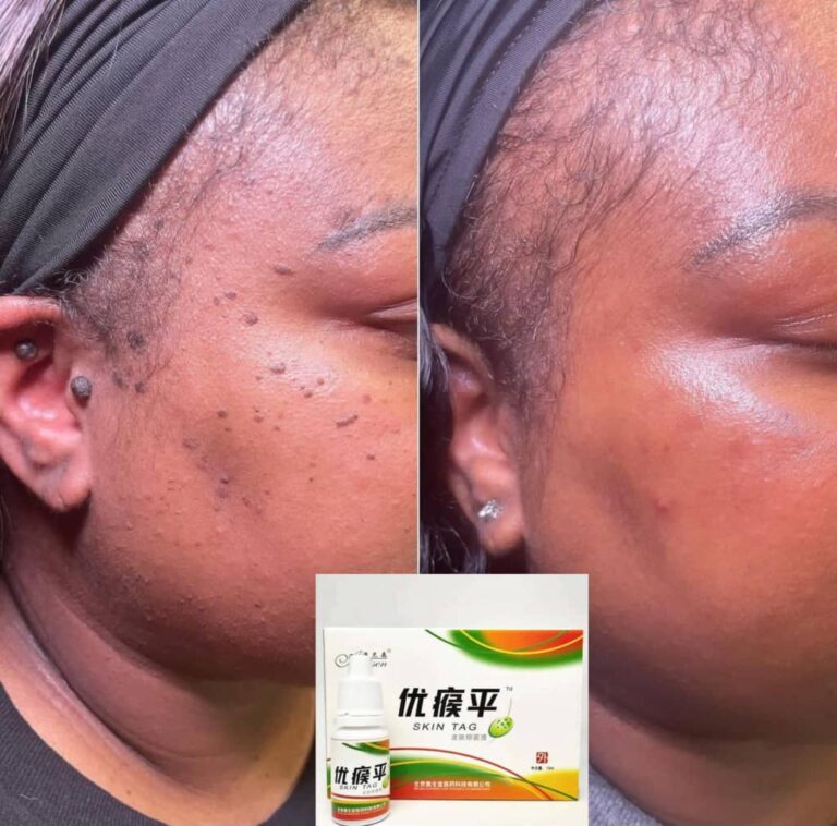 skin-tag-3