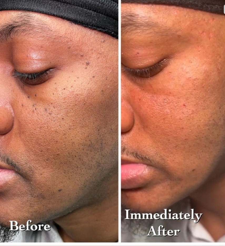 skin-tag-5